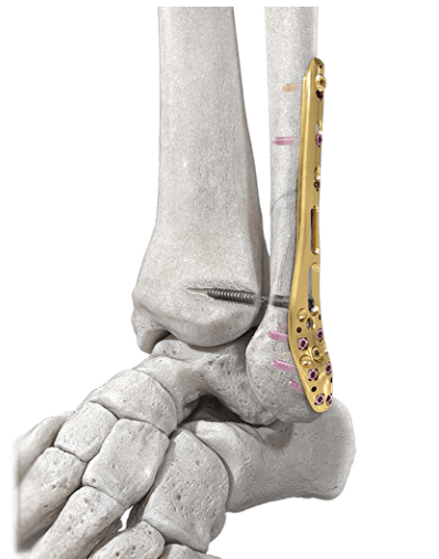Osteosíntesis